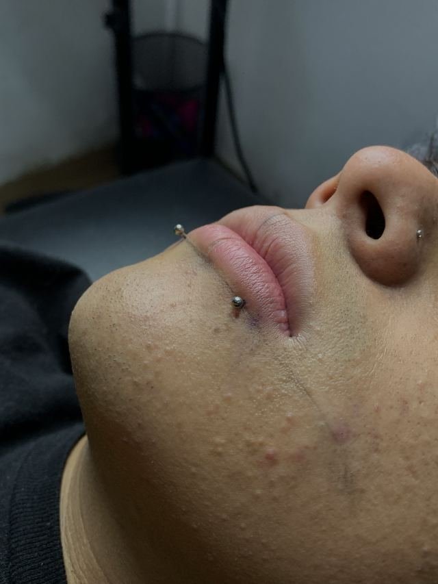 Perforación Snike bites